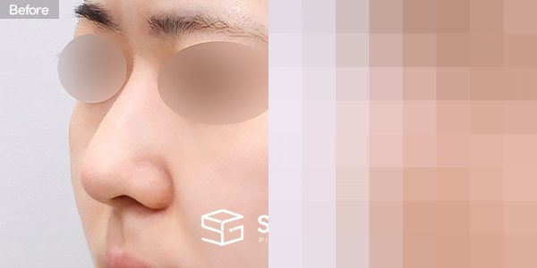 슈가성형외과 첫) 콧대 + 코끝 + 비중격연골 + 귀연골 + 매부리 + 절골 + 휜코 + 복코 + 비공내리기 전후사진 - 정면 수술 전후 비교