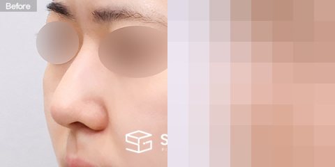 슈가성형외과 첫) 콧대 + 코끝 + 비중격연골 + 귀연골 + 매부리 + 절골 + 휜코 + 복코 + 비공내리기 전후사진 - 정면 수술 전후 비교