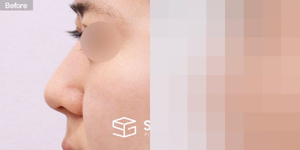 슈가성형외과 첫) 콧대 + 코끝 + 비중격연골 + 귀연골 + 매부리 + 절골 + 휜코 + 복코 + 비공내리기 전후사진 - 45도 수술 전후 비교