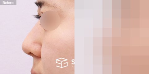 슈가성형외과 첫) 콧대 + 코끝 + 비중격연골 + 귀연골 + 매부리 + 절골 + 휜코 + 복코 + 비공내리기 전후사진 - 45도 수술 전후 비교