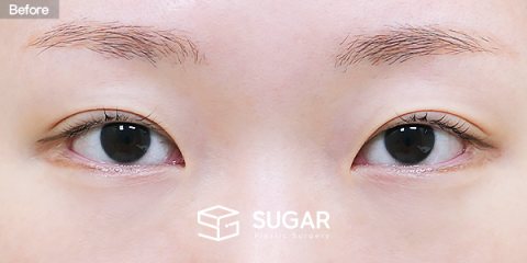 슈가성형외과 재) 재수술 + 뒤밑트임 전후사진 - 수술 전