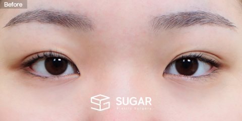 슈가성형외과 첫) 자연유착 + 눈매교정 + 앞트임 + 윗트임 전후사진 - 수술 전