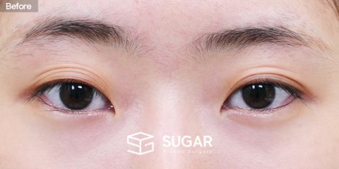 슈가성형외과 첫) 자연유착 + 눈매교정 전후사진 - 수술 전