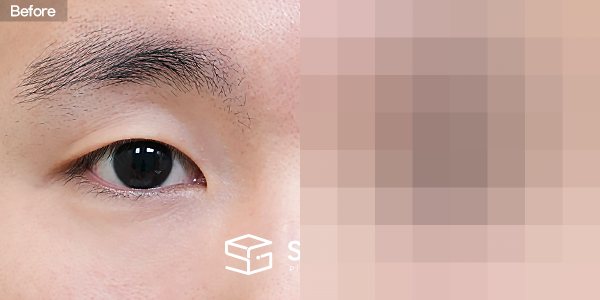 슈가성형외과 첫) 자연유착 + 눈매교정 + 뒤밑트임 전후사진 - 정면 수술 전후 비교