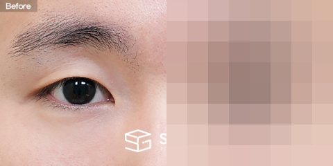 슈가성형외과 첫) 자연유착 + 눈매교정 + 뒤밑트임 전후사진 - 정면 수술 전후 비교