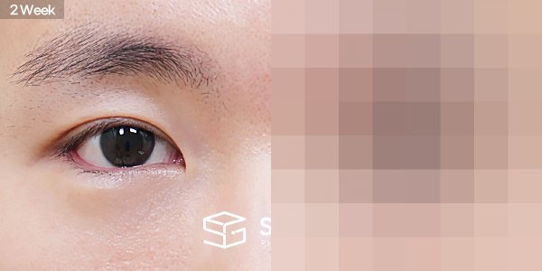 슈가성형외과 첫) 자연유착 + 눈매교정 + 뒤밑트임 전후사진 - 45도 수술 전후 비교
