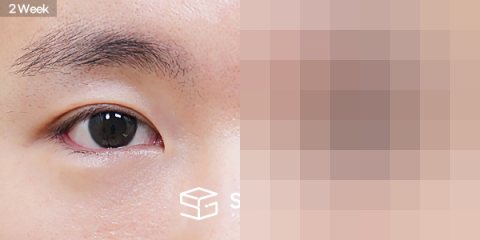 슈가성형외과 첫) 자연유착 + 눈매교정 + 뒤밑트임 전후사진 - 45도 수술 전후 비교