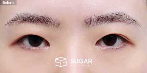 슈가성형외과 재) 재수술 + 절개 + 눈매교정 + 앞트임 전후사진 - 수술 전