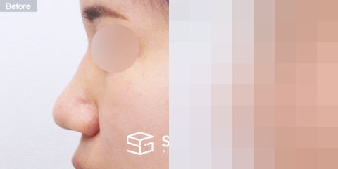 슈가성형외과 첫) 콧대 + 코끝 + 비중격연골 + 귀연골 + 매부리 + 절골 + 콧볼축소 + 복코 전후사진 - 45도 수술 전후 비교