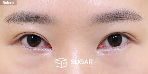 슈가성형외과 재) 재수술 + 뒤밑트임 전후사진 - 수술 전