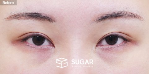 슈가성형외과 첫) 뒤밑트임 + 눈밑지방재배치 전후사진 - 수술 전
