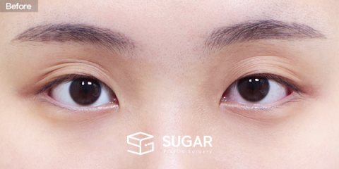 슈가성형외과 첫) 자연유착 + 눈매교정 + 앞트임 전후사진 - 수술 전