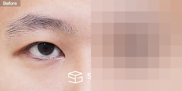 슈가성형외과 재) 재수술 + 절개 + 눈매교정 + 뒤트임 전후사진 - 정면 수술 전후 비교