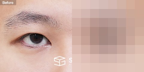 슈가성형외과 재) 재수술 + 절개 + 눈매교정 + 뒤트임 전후사진 - 정면 수술 전후 비교