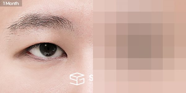 슈가성형외과 재) 재수술 + 절개 + 눈매교정 + 뒤트임 전후사진 - 45도 수술 전후 비교