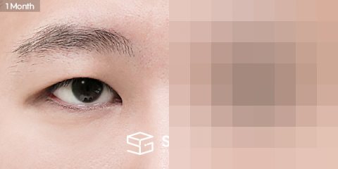 슈가성형외과 재) 재수술 + 절개 + 눈매교정 + 뒤트임 전후사진 - 45도 수술 전후 비교