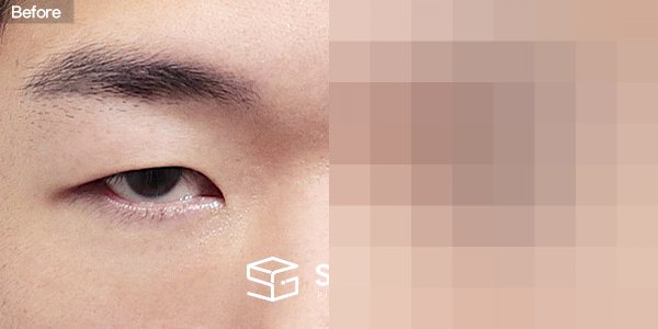 슈가성형외과 첫) 눈썹하거상술 + 뒤밑트임 전후사진 - 정면 수술 전후 비교