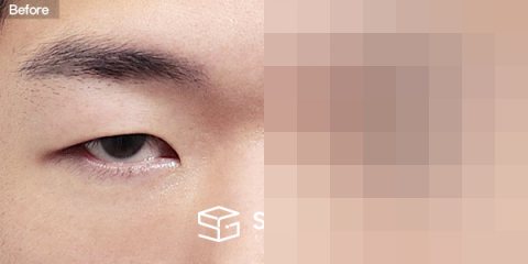슈가성형외과 첫) 눈썹하거상술 + 뒤밑트임 전후사진 - 정면 수술 전후 비교