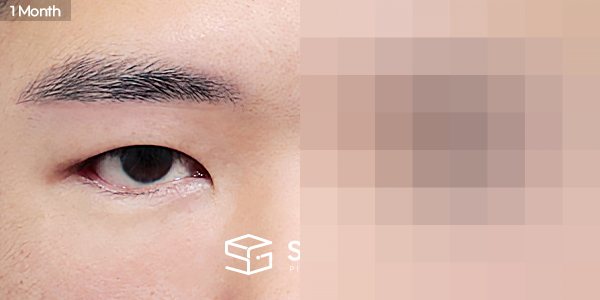 슈가성형외과 첫) 눈썹하거상술 + 뒤밑트임 전후사진 - 45도 수술 전후 비교