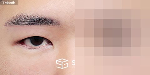 슈가성형외과 첫) 눈썹하거상술 + 뒤밑트임 전후사진 - 45도 수술 전후 비교
