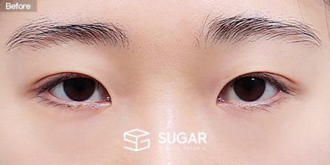 슈가성형외과 재) 재수술 + 뒤밑트임 전후사진 - 수술 전