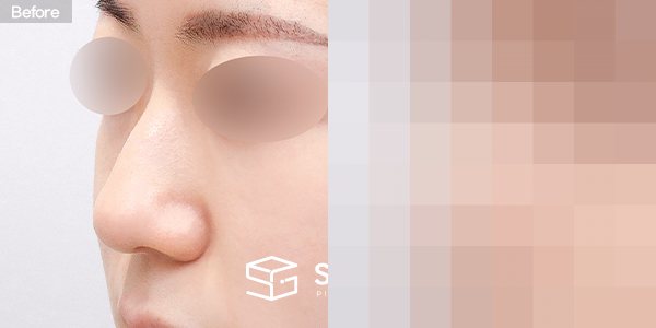 슈가성형외과 첫) 무보형물 + 비중격연골 + 귀연골 + 매부리 + 복코 + 귀 뒤 근막 전후사진 - 정면 수술 전후 비교