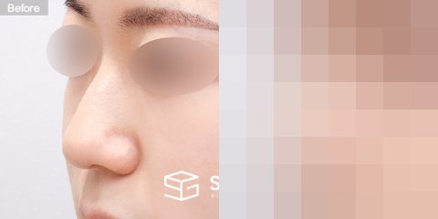 슈가성형외과 첫) 무보형물 + 비중격연골 + 귀연골 + 매부리 + 복코 + 귀 뒤 근막 전후사진 - 정면 수술 전후 비교