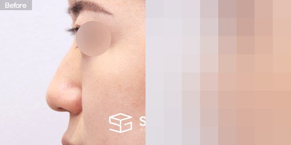 슈가성형외과 첫) 무보형물 + 비중격연골 + 귀연골 + 매부리 + 복코 + 귀 뒤 근막 전후사진 - 45도 수술 전후 비교