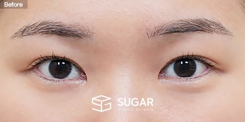 슈가성형외과 첫) 뒤밑트임 전후사진 - 수술 전