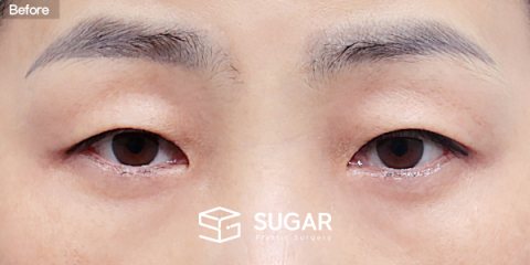슈가성형외과 첫) 눈썹하거상술 + 자연유착 + 눈매교정 + 윗트임 전후사진 - 수술 전