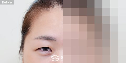 슈가성형외과 첫) 이마거상 + 자연유착 + 눈 두덩이 지방 제거 + 윗트임 + 뒤밑트임 전후사진 - 정면 수술 전후 비교