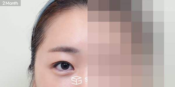 슈가성형외과 첫) 이마거상 + 자연유착 + 눈 두덩이 지방 제거 + 윗트임 + 뒤밑트임 전후사진 - 45도 수술 전후 비교
