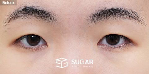 슈가성형외과 첫) 자연유착 + 눈매교정 + 윗트임 + 앞트임 전후사진 - 수술 전