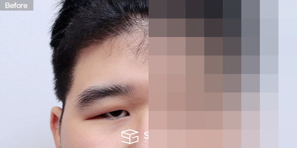 슈가성형외과 첫) 이마거상 + 절개 + 눈매교정 + 눈 두덩이 지방 제거 전후사진 - 정면 수술 전후 비교