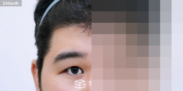 슈가성형외과 첫) 이마거상 + 절개 + 눈매교정 + 눈 두덩이 지방 제거 전후사진 - 45도 수술 전후 비교