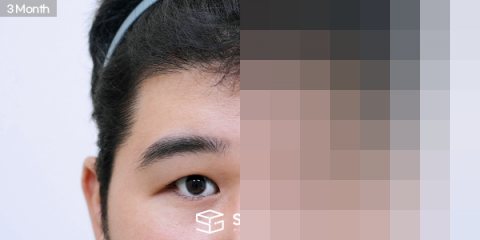 슈가성형외과 첫) 이마거상 + 절개 + 눈매교정 + 눈 두덩이 지방 제거 전후사진 - 45도 수술 전후 비교