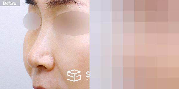슈가성형외과 첫) 콧대 + 코끝 + 귀연골 + 비중격연골 + 복코 전후사진 - 정면 수술 전후 비교