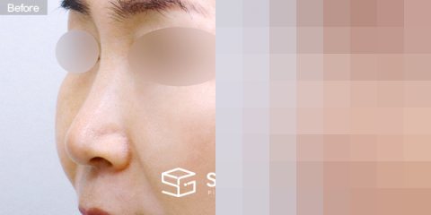 슈가성형외과 첫) 콧대 + 코끝 + 귀연골 + 비중격연골 + 복코 전후사진 - 정면 수술 전후 비교