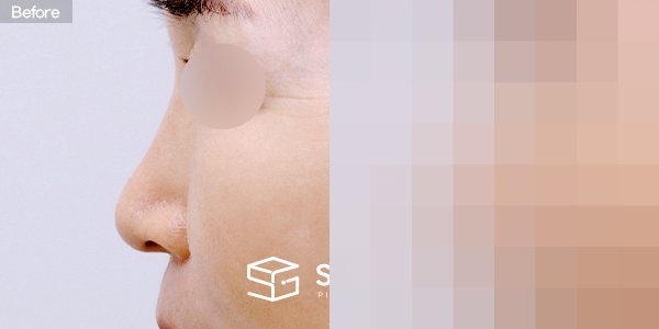 슈가성형외과 첫) 콧대 + 코끝 + 귀연골 + 비중격연골 + 복코 전후사진 - 45도 수술 전후 비교