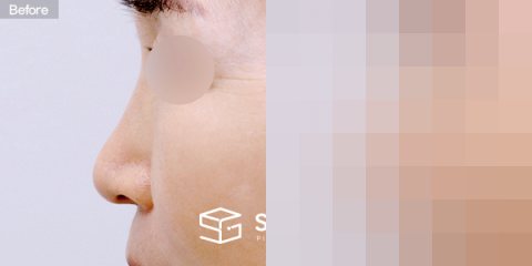 슈가성형외과 첫) 콧대 + 코끝 + 귀연골 + 비중격연골 + 복코 전후사진 - 45도 수술 전후 비교