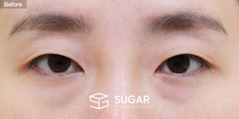 슈가성형외과 첫) 자연유착 + 눈매교정 + 윗트임 전후사진 - 수술 전