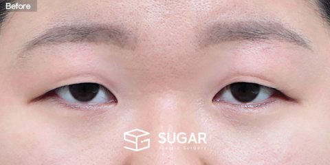 슈가성형외과 첫) 눈썹하거상술 + 눈 두덩이 지방 제거 전후사진 - 수술 전