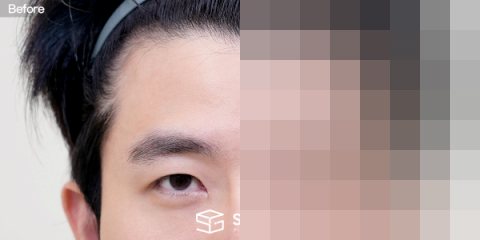 슈가성형외과 첫) 이마거상 + 뒤트임 전후사진 - 정면 수술 전후 비교
