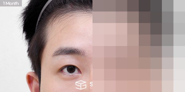 슈가성형외과 첫) 이마거상 + 뒤트임 전후사진 - 45도 수술 전후 비교