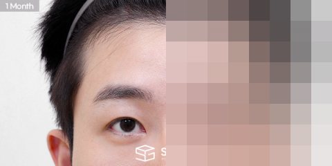 슈가성형외과 첫) 이마거상 + 뒤트임 전후사진 - 45도 수술 전후 비교