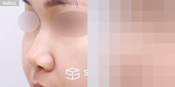 슈가성형외과 첫) 콧대 + 코끝 + 비중격연골 + 귀연골 + 복코 전후사진 - 정면 수술 전후 비교