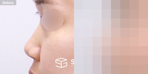 슈가성형외과 첫) 콧대 + 코끝 + 비중격연골 + 귀연골 + 복코 전후사진 - 45도 수술 전후 비교