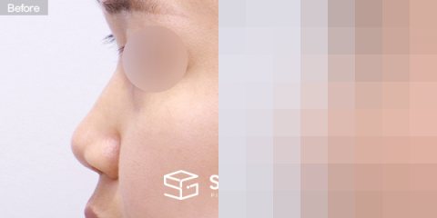슈가성형외과 첫) 콧대 + 코끝 + 비중격연골 + 귀연골 + 복코 전후사진 - 45도 수술 전후 비교