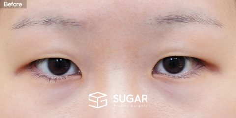 슈가성형외과 첫) 자연유착 + 눈매교정 + 앞트임 전후사진 - 수술 전