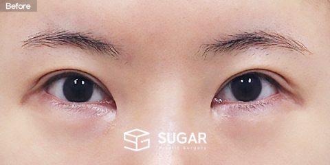 슈가성형외과 재) 앞트임 복원 + 뒤트임 재수술 전후사진 - 수술 전